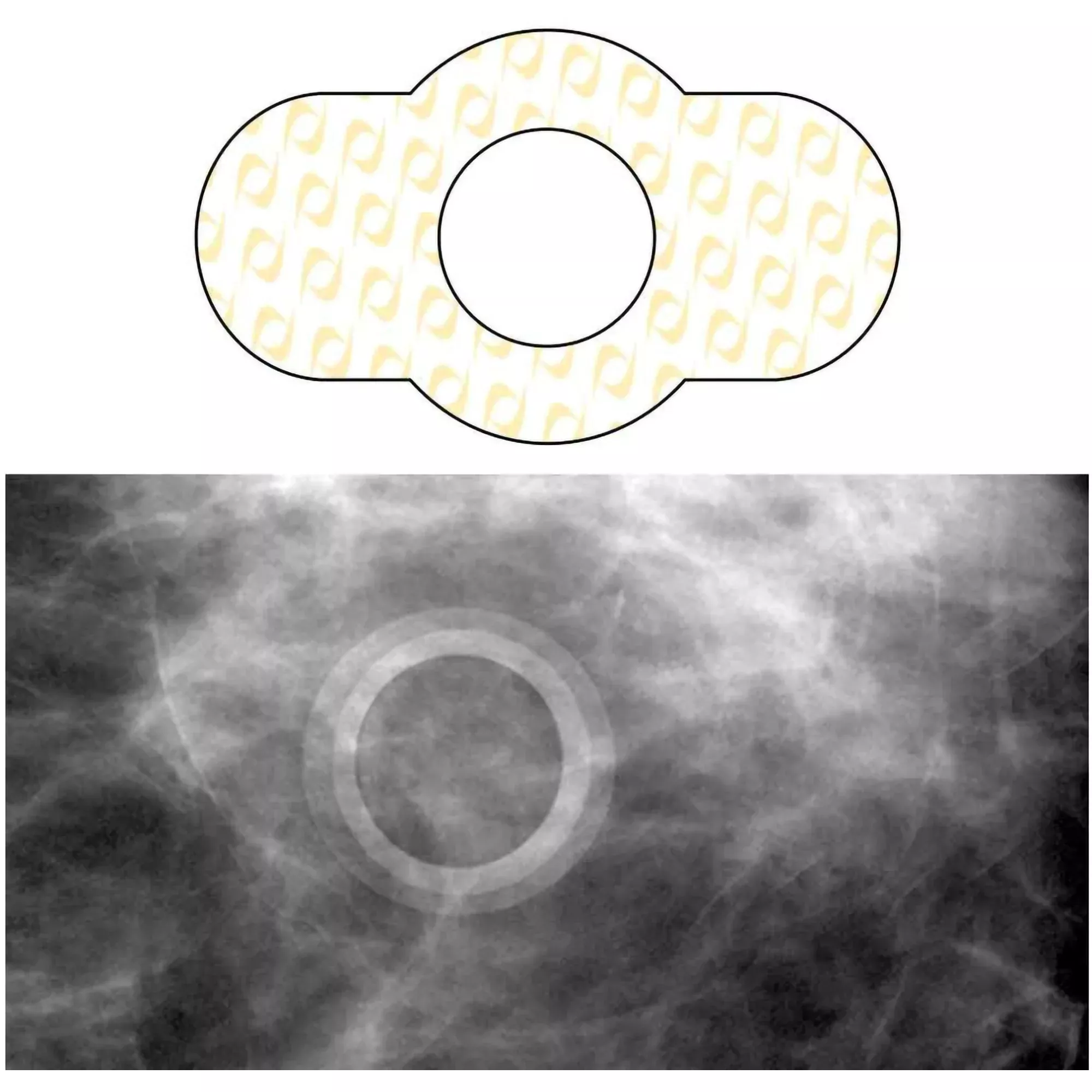 Spee-D-Ring™ Skin Marker, 1 Box of 100
