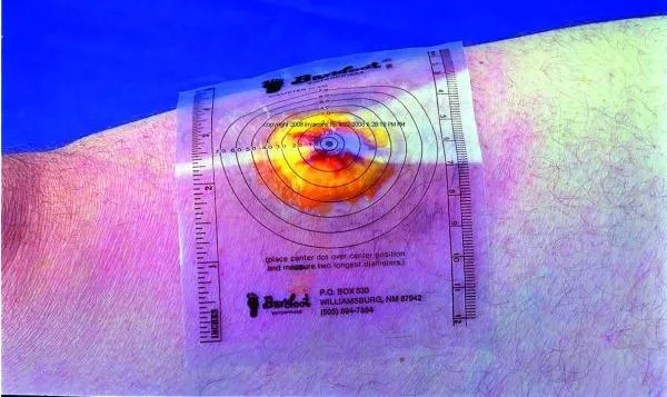 Trademark Medical Wound Measuring Guide, 1 Box of 250